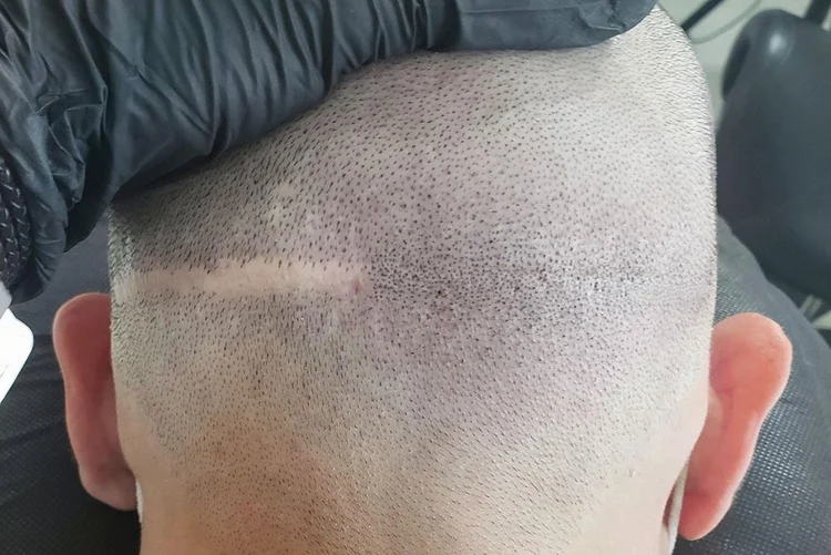 Prima e dopo della tricopigmentazione su cicatrice del cuoio capelluto dopo trapianto