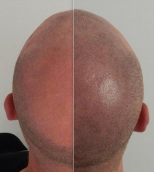 Prima e dopo correzione tricopigmentazione vertex con distribuzione naturale dei punti HRDD