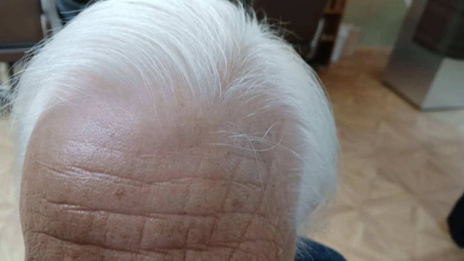 Hair line Hair loss Saxmundham Wickham Market.jpeg