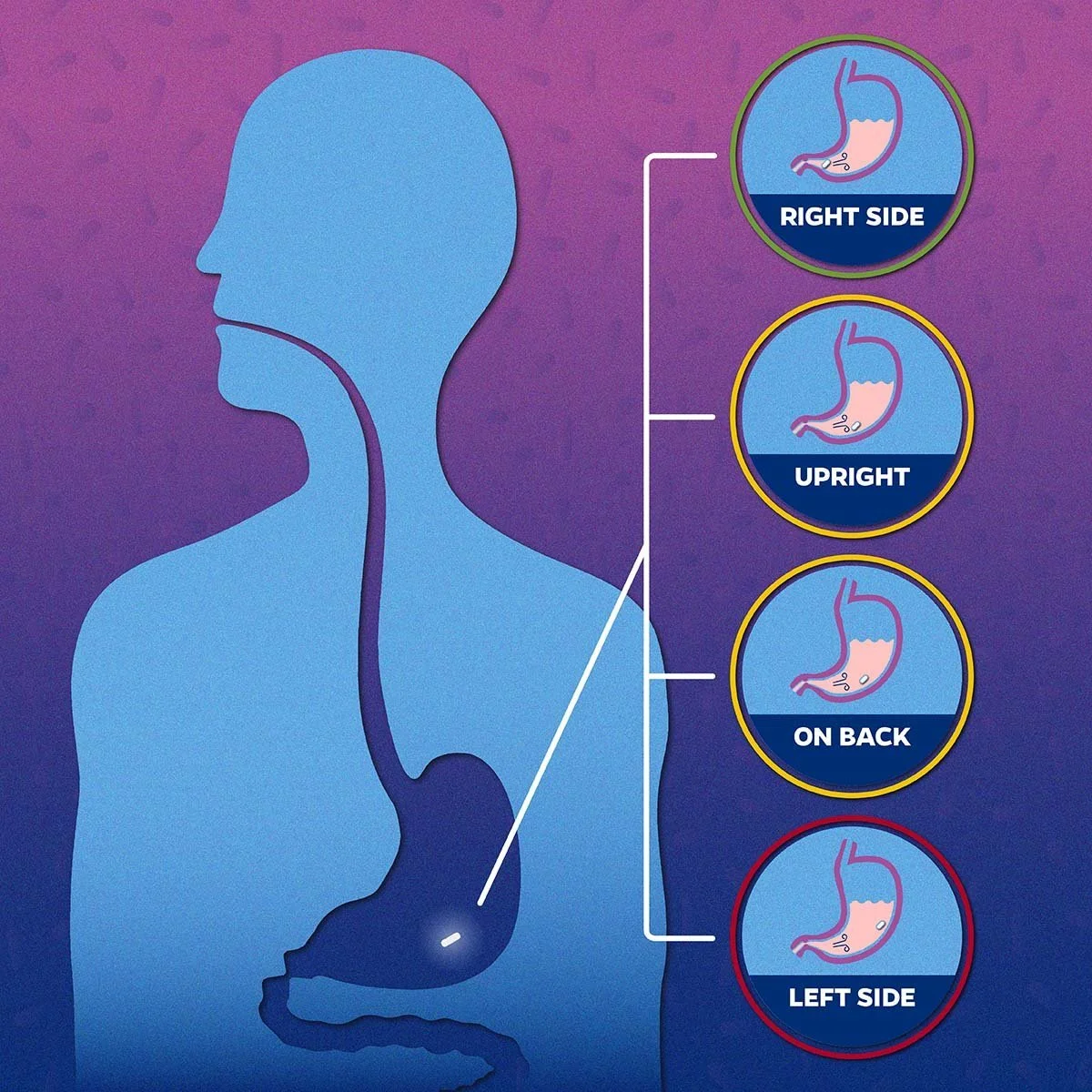 Diagram illustrating the different positions of a stomach during medical procedures, with labels for right side, upright, on back, and left side.