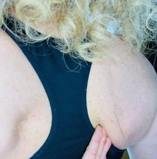 Winging Scapulae.jpeg