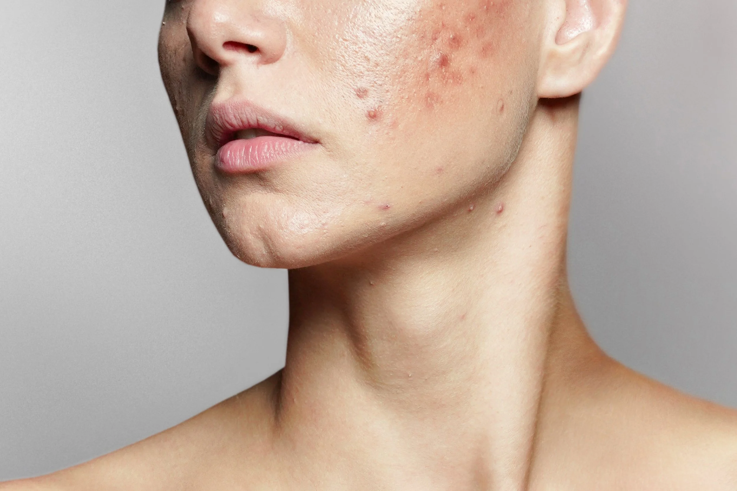 Close-up of a person's face and neck showing acne and skin blemishes.