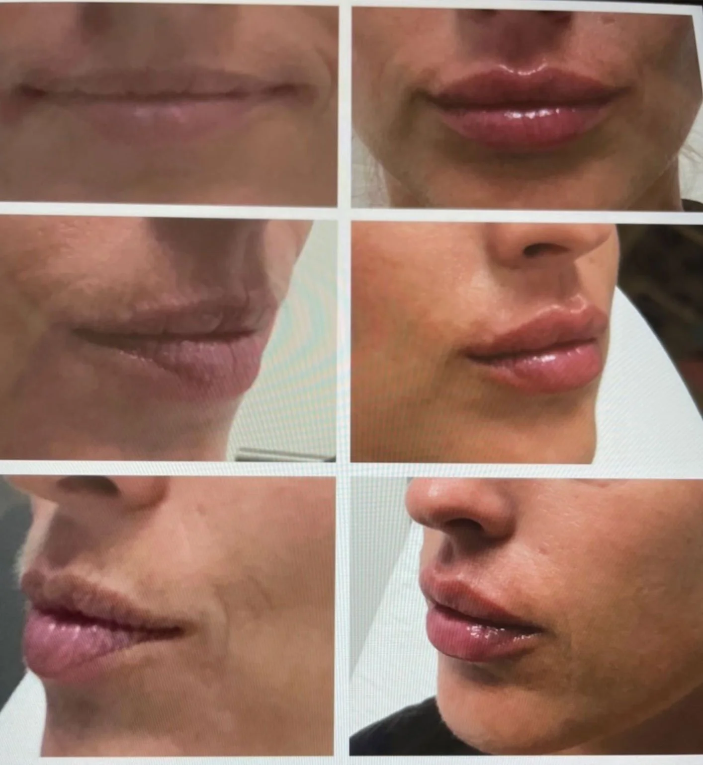Please-Add-before-and-after-lips.jpg