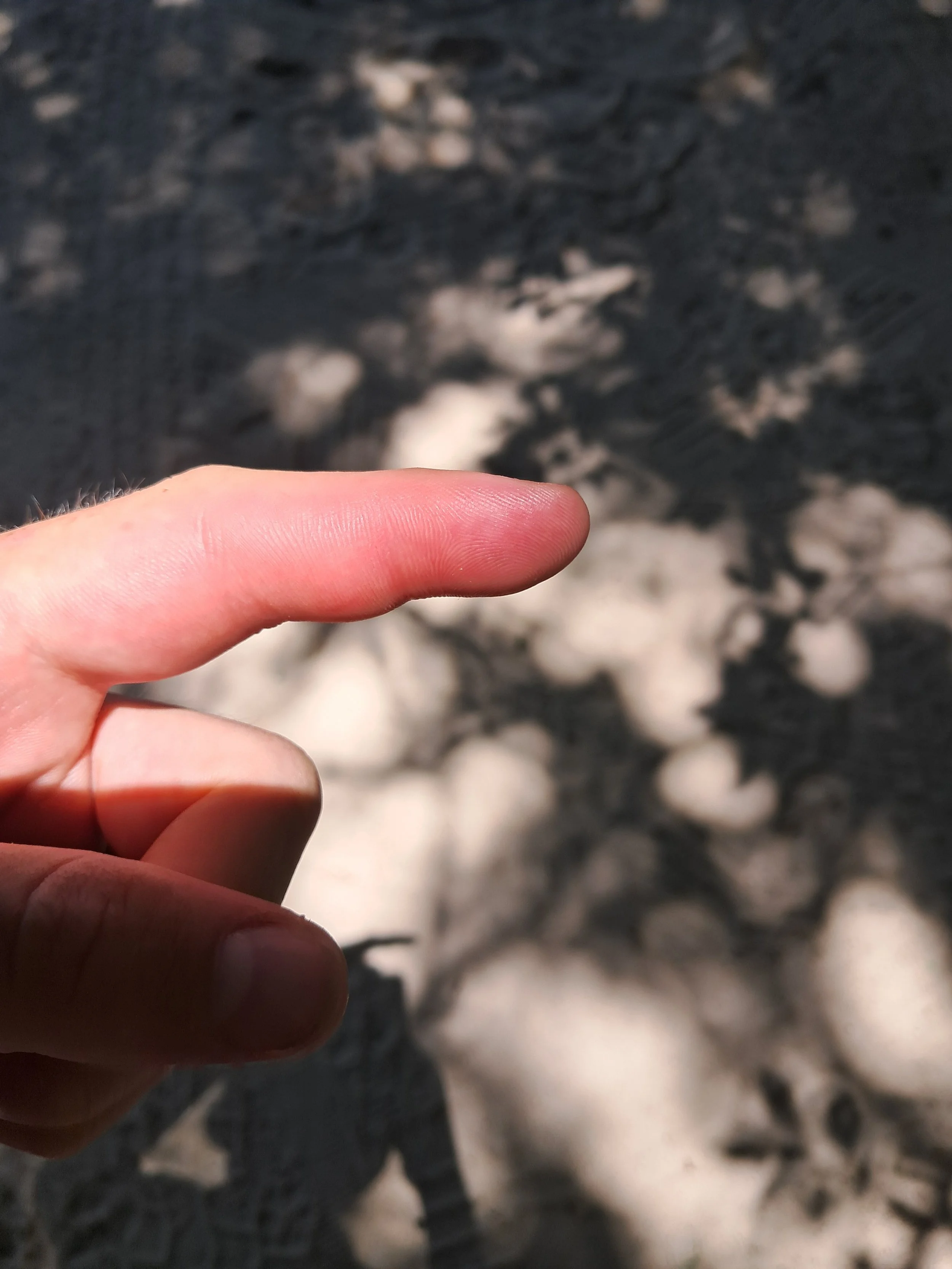 Bibron’s Stiletto Snakebite 10mins after (Atractaspis bibronii)