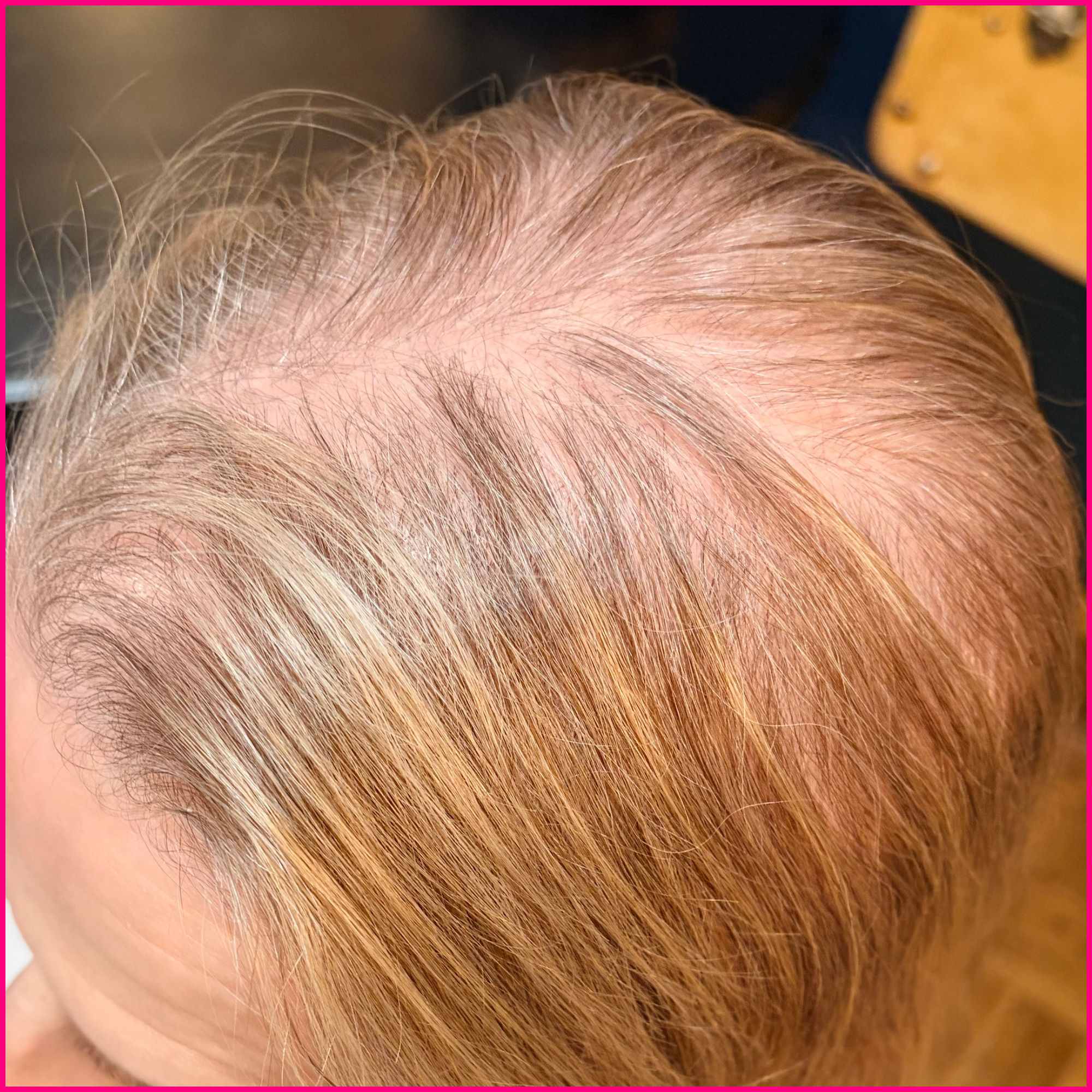 Close-up of thinning light brown hair and visible scalp at the crown