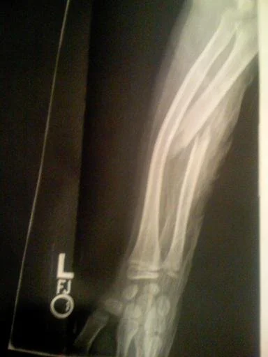 armfracture.jpg