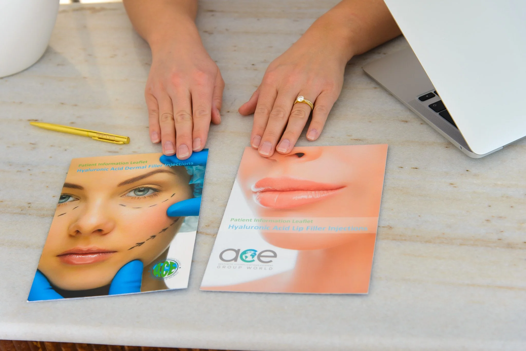 Two brochures about hyaluronic acid lip and dermal filler injections on a marble table, with a person’s hands resting near the brochures, a laptop partially visible on the right, and a yellow pen on the left.