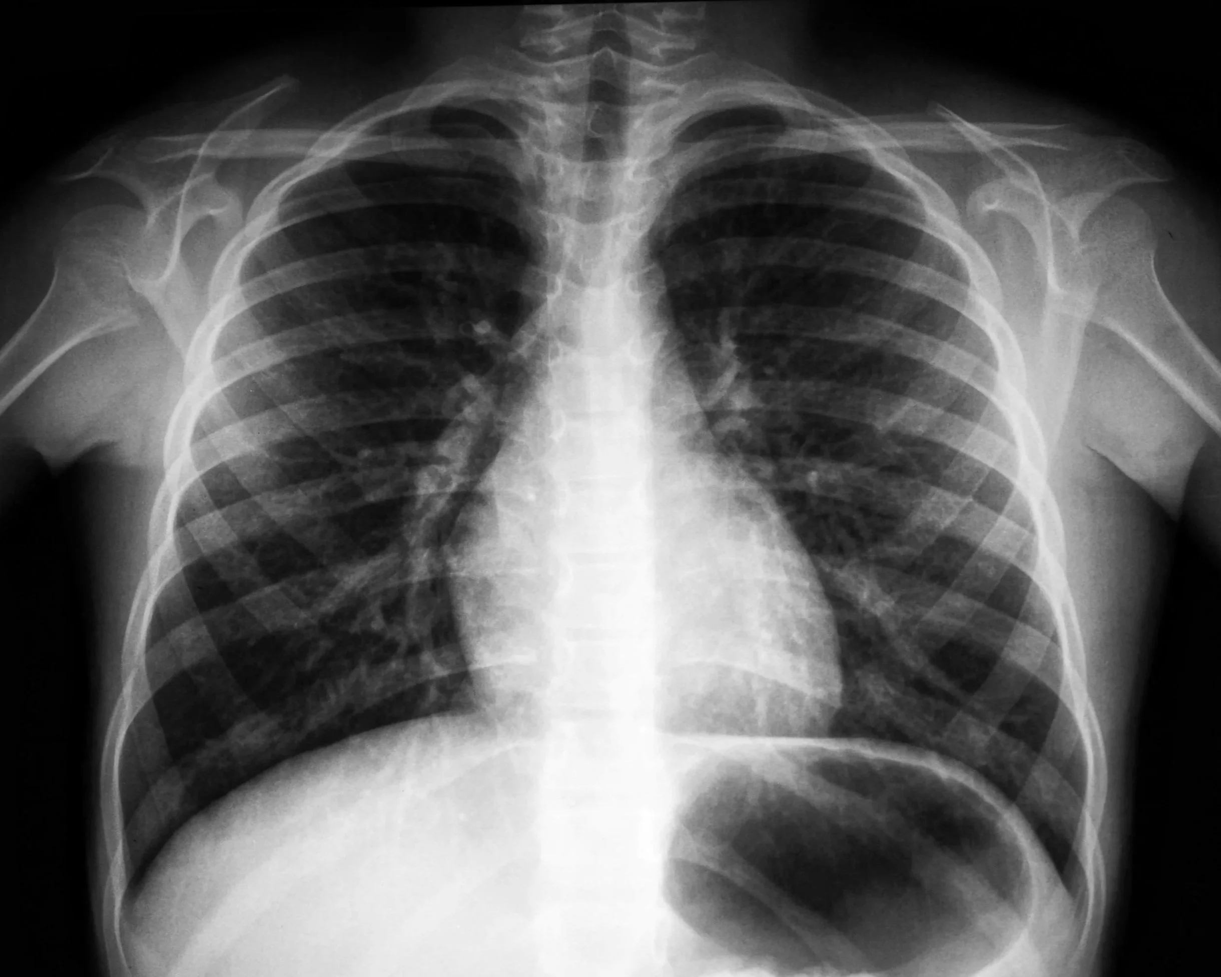 X-ray image of a human thorax showing ribs, spine, and shoulder joints.