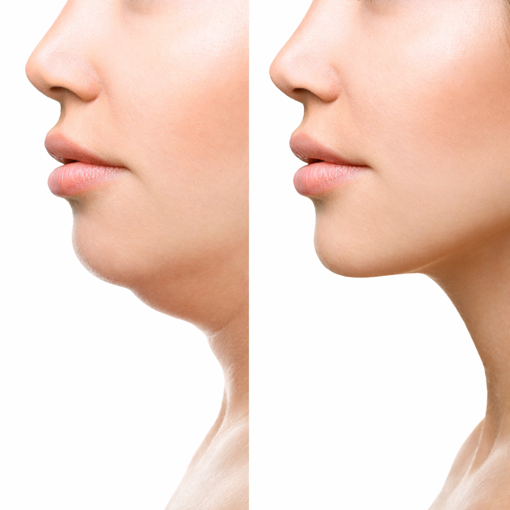 Lipolyse (Fett-weg-Spritze) 1.png