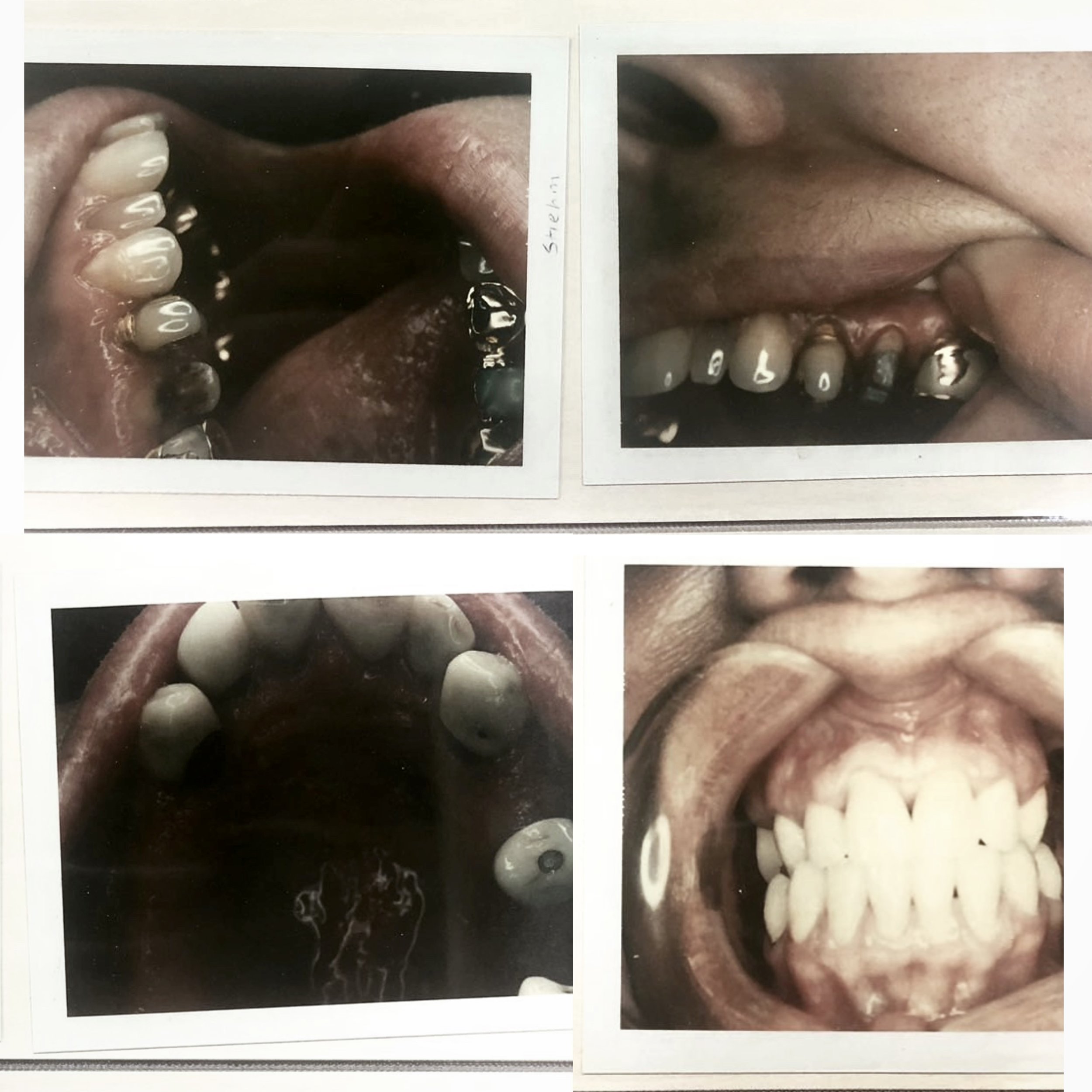 TAKING TEETH - Album