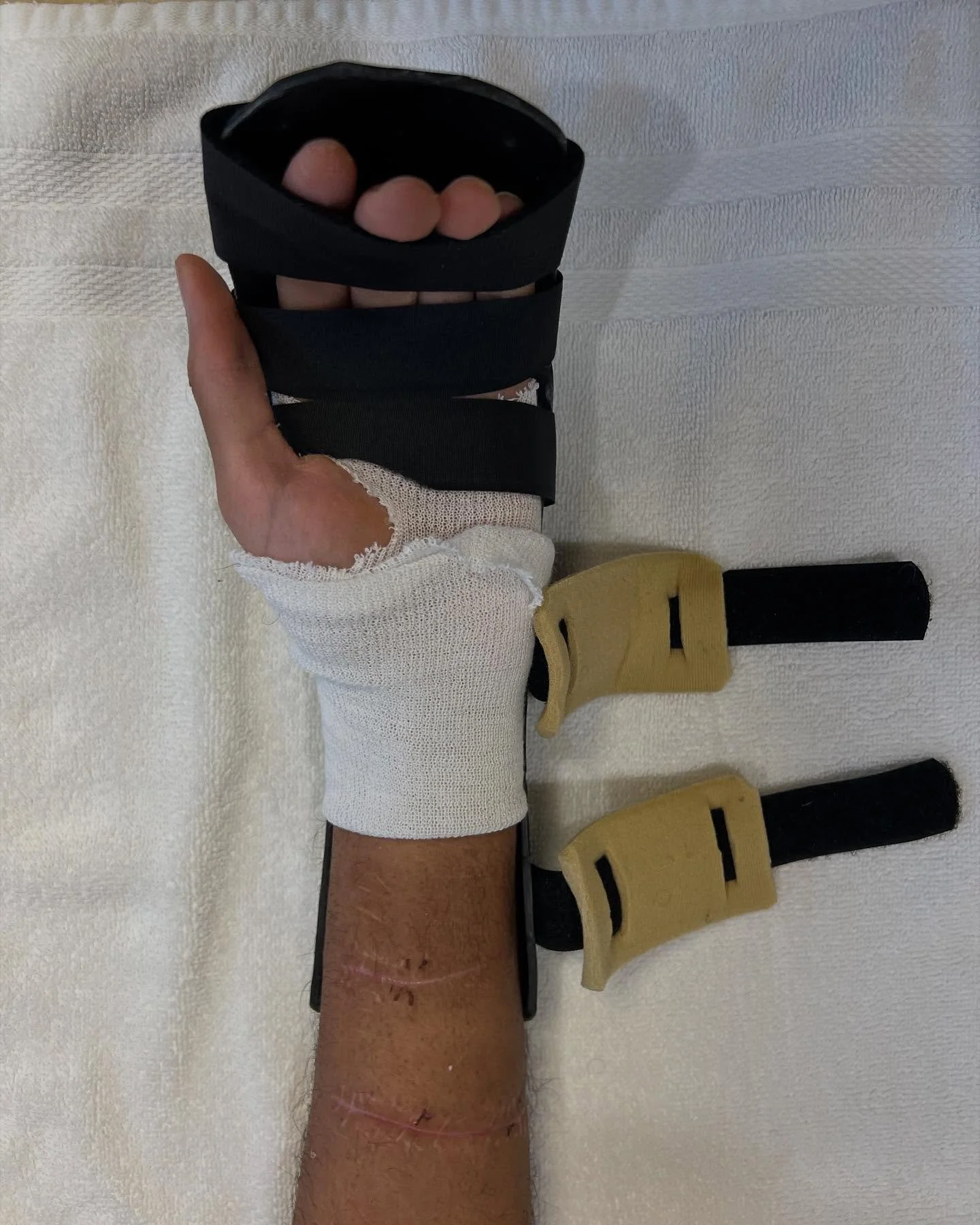 This patient sustained a laceration leading to repair of the FCR and FCU tendons and 3 FDS tendons. 

The lacerations happened in zone V at the musculotendinous junction. Due to the intricate repairs at this juncture, progression was done slowly and 