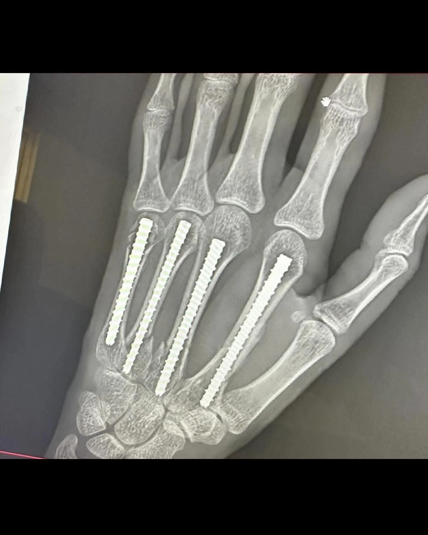This patient was involved in a motorcycle accident leading to displaced fractures of digits 2-5 metacarpals.
This patient underwent an ORIF with intramedullary screws to digits 2-5.
At the end of the slides is an excellent instructional animation