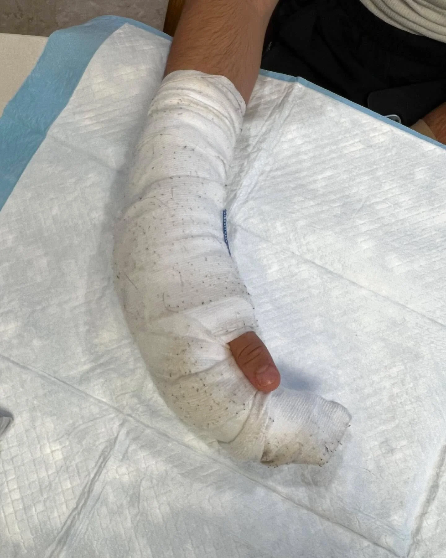 This patient presents s/p stage II flexor tendon repair.
They presented to the surgeon 1 month after a jersey finger injury. Due to the delay, the surgeon decided on a two stage flexor tendon repair.
Stage I consisted of utilizing a Hunter rod to