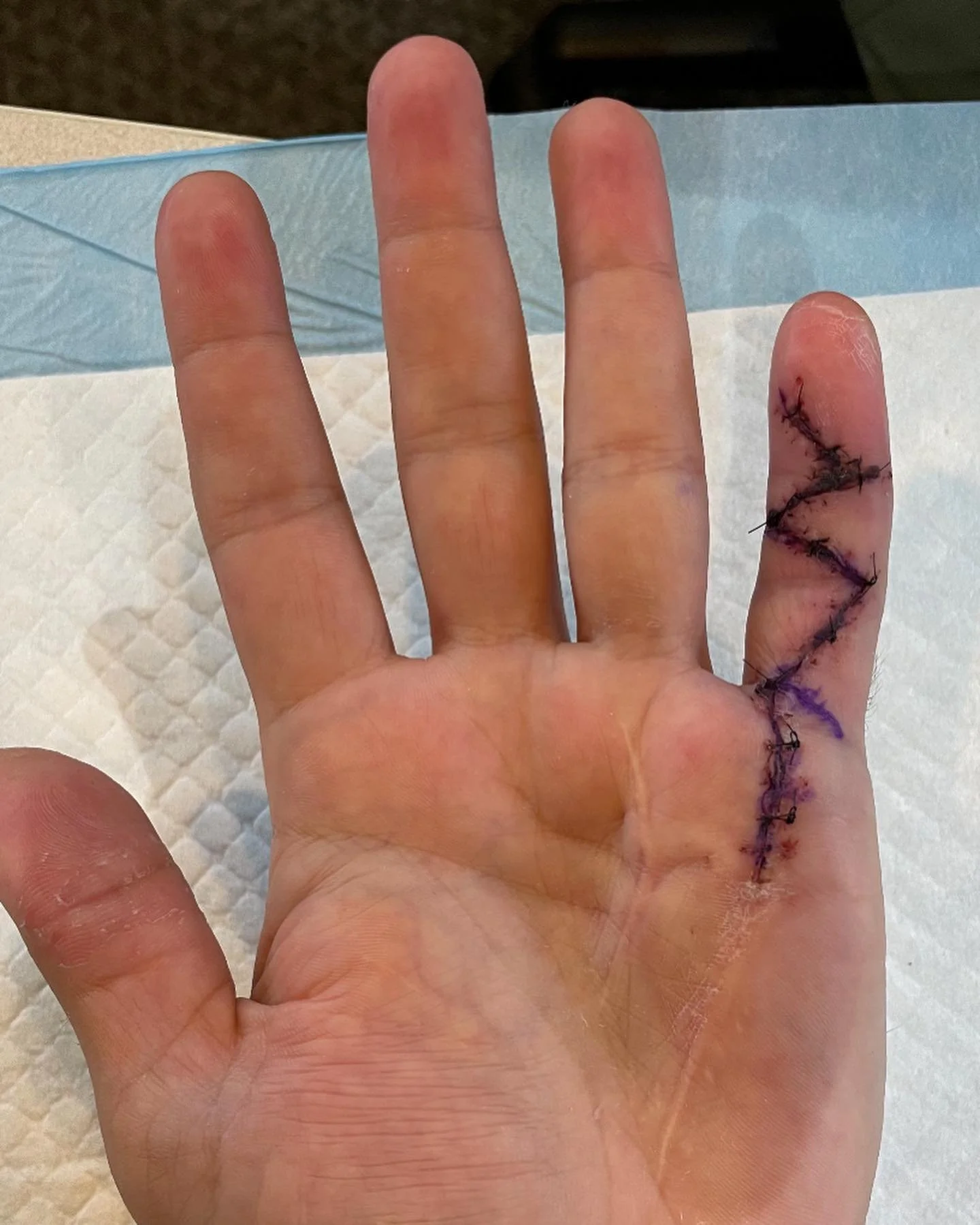 This patient presented to therapy s/p fasciectomy and digital nerve neurolysis.
They have a history of recurring Dupuytren’s disease. This was the 3rd surgery to address a small finger contracture.
The patient was provided with an extension