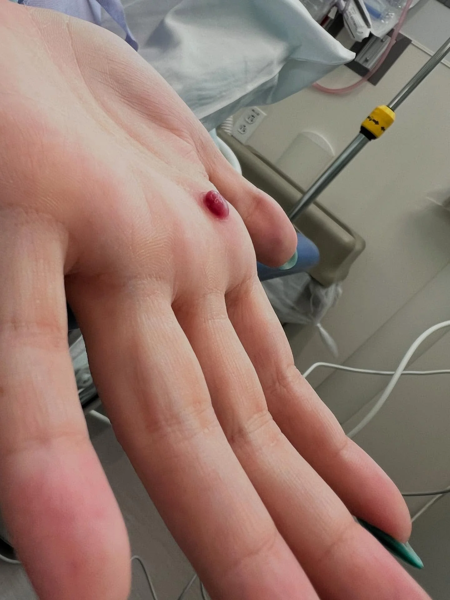 Pyogenic Granulomas develop as benign vascular tumors with rapid vascular growth. Silver nitrate is the first line of treatment.
This patient developed a Pyogenic Granuloma after pinching their hand while cutting. After multiple rounds of silver ni