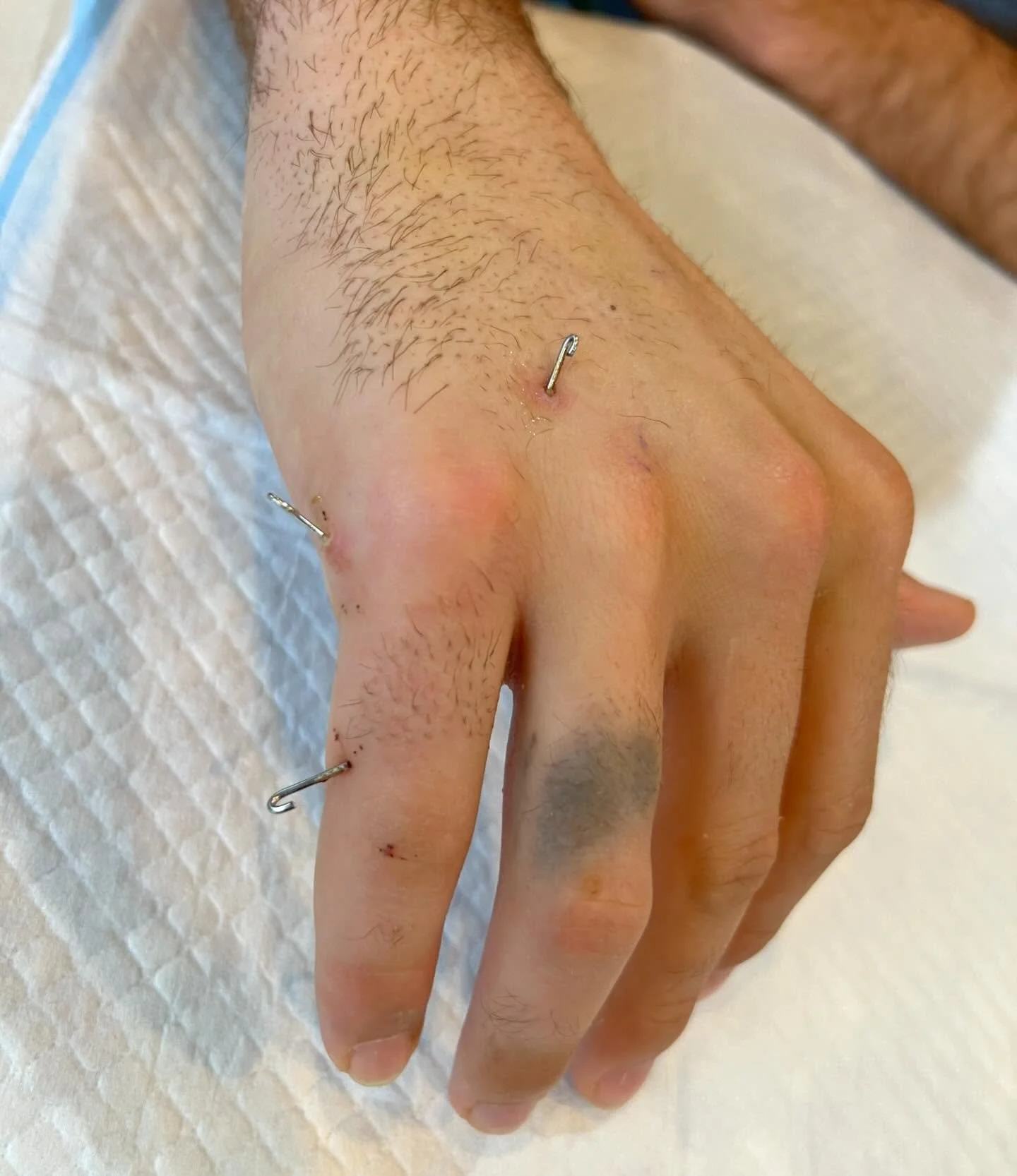 This patient sustained a small finger proximal phalanx fracture while playing basketball. 

He underwent percutaneous pinning of proximal phalanx. He began therapy at 3 weeks and will have the K-wires removed at 6 weeks post-op. 

A hand based ulnar 
