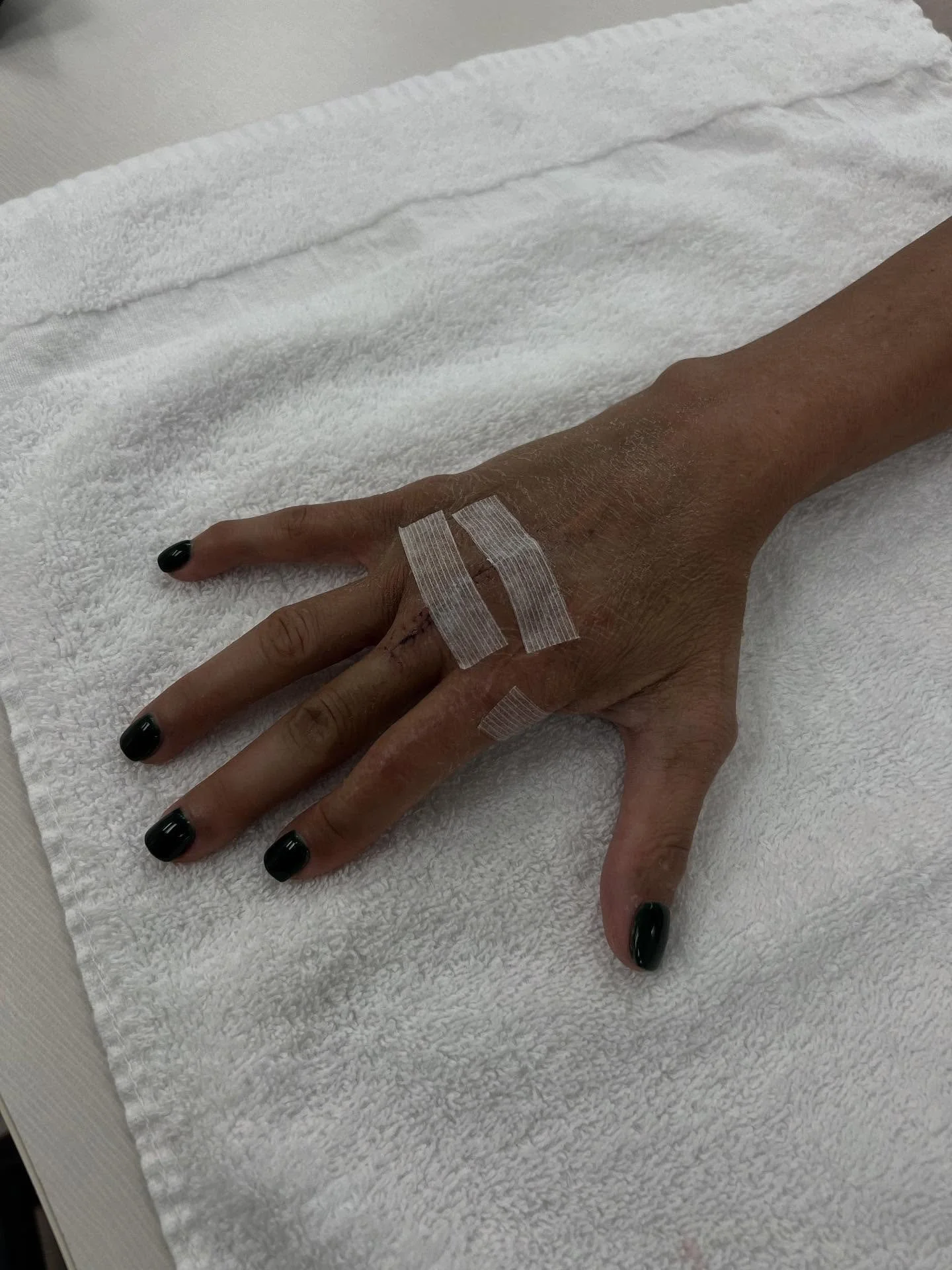 This patient presents with a history of index finger fusion and middle finger MCP Arthroplasty. 

The patient experienced a fracture of the previous implant to the long finger MCP. 

The patient underwent excision of the implant to right long finger,