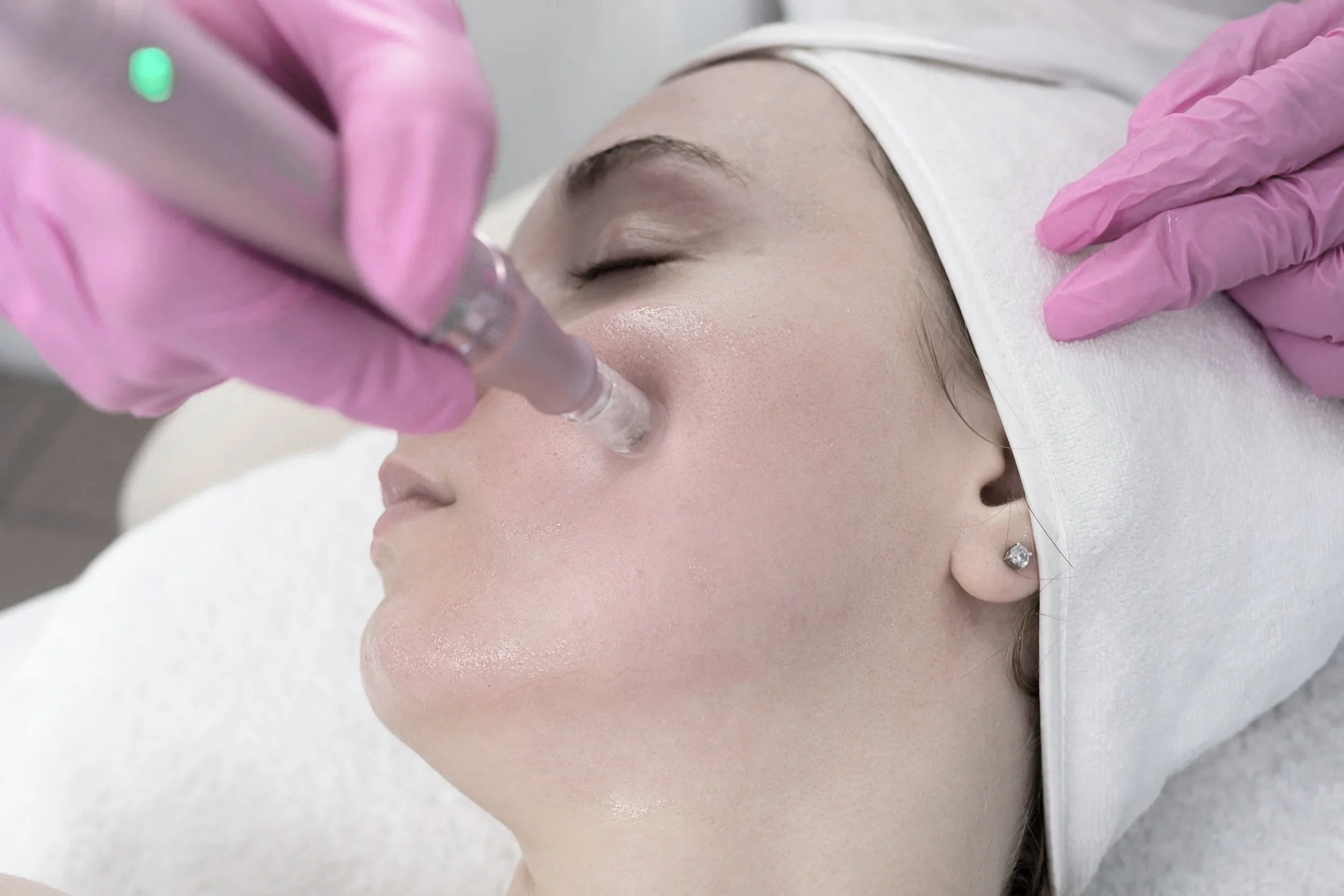 microneedling