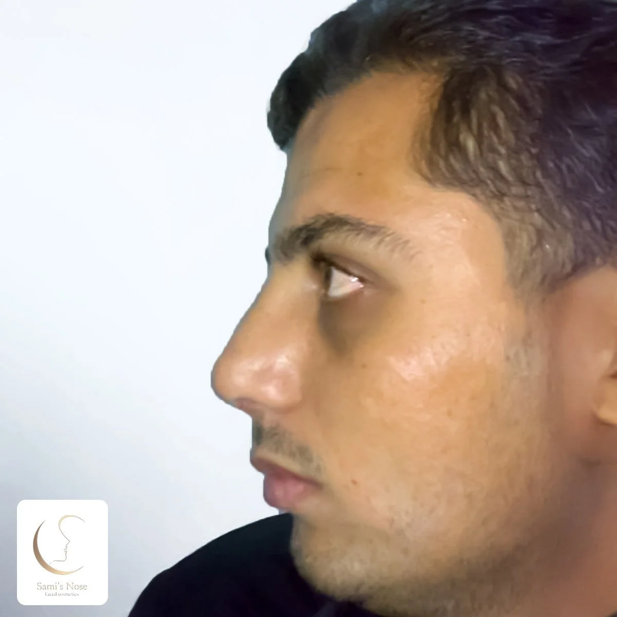 Patient 2 After Rhinoplasty