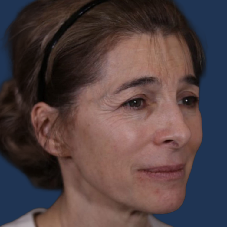 Before facelift at The Ghanem Clinic