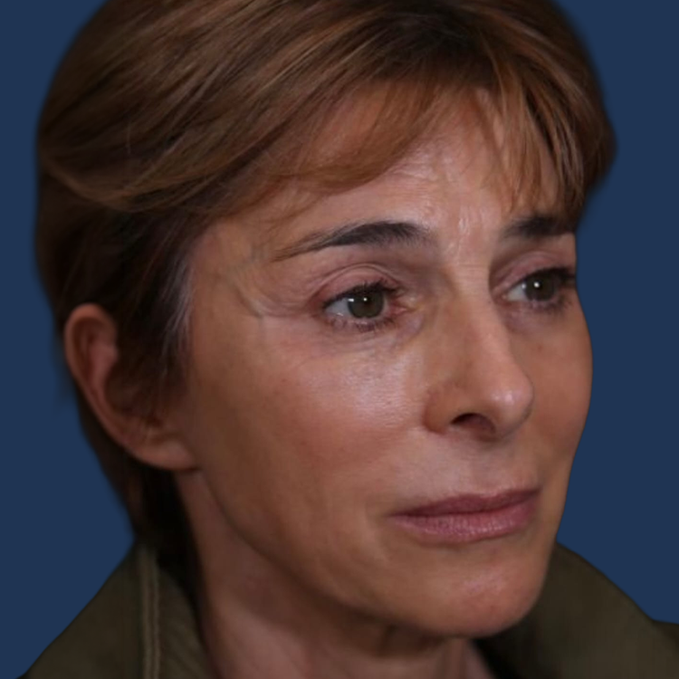 After facelift at The Ghanem Clinic