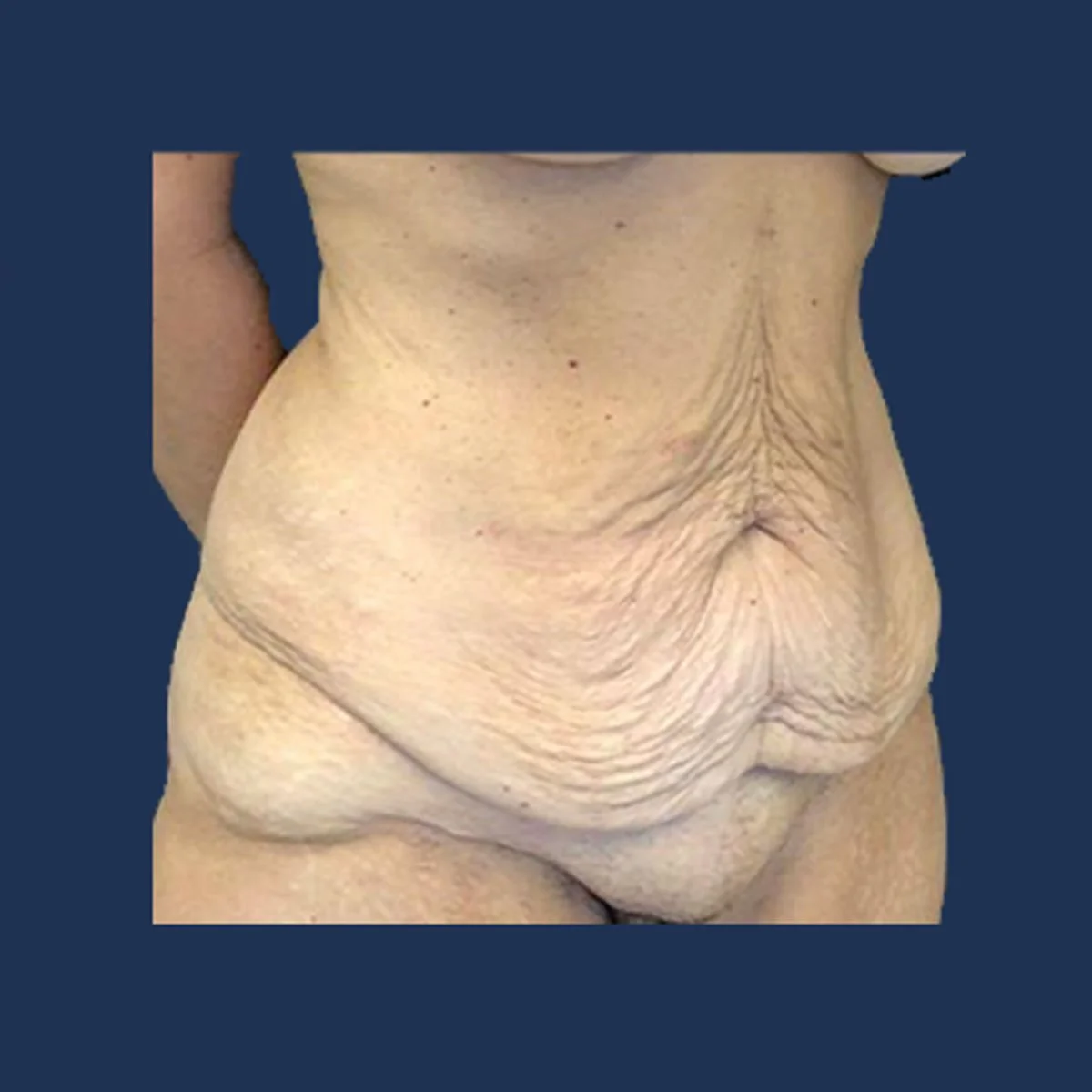 Patient 1 Before Tummy Tuck