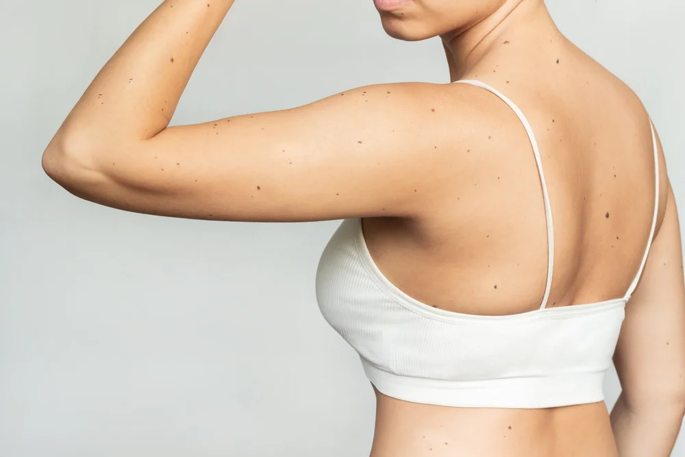 Body Lifts: Arm, Buttock, Thigh