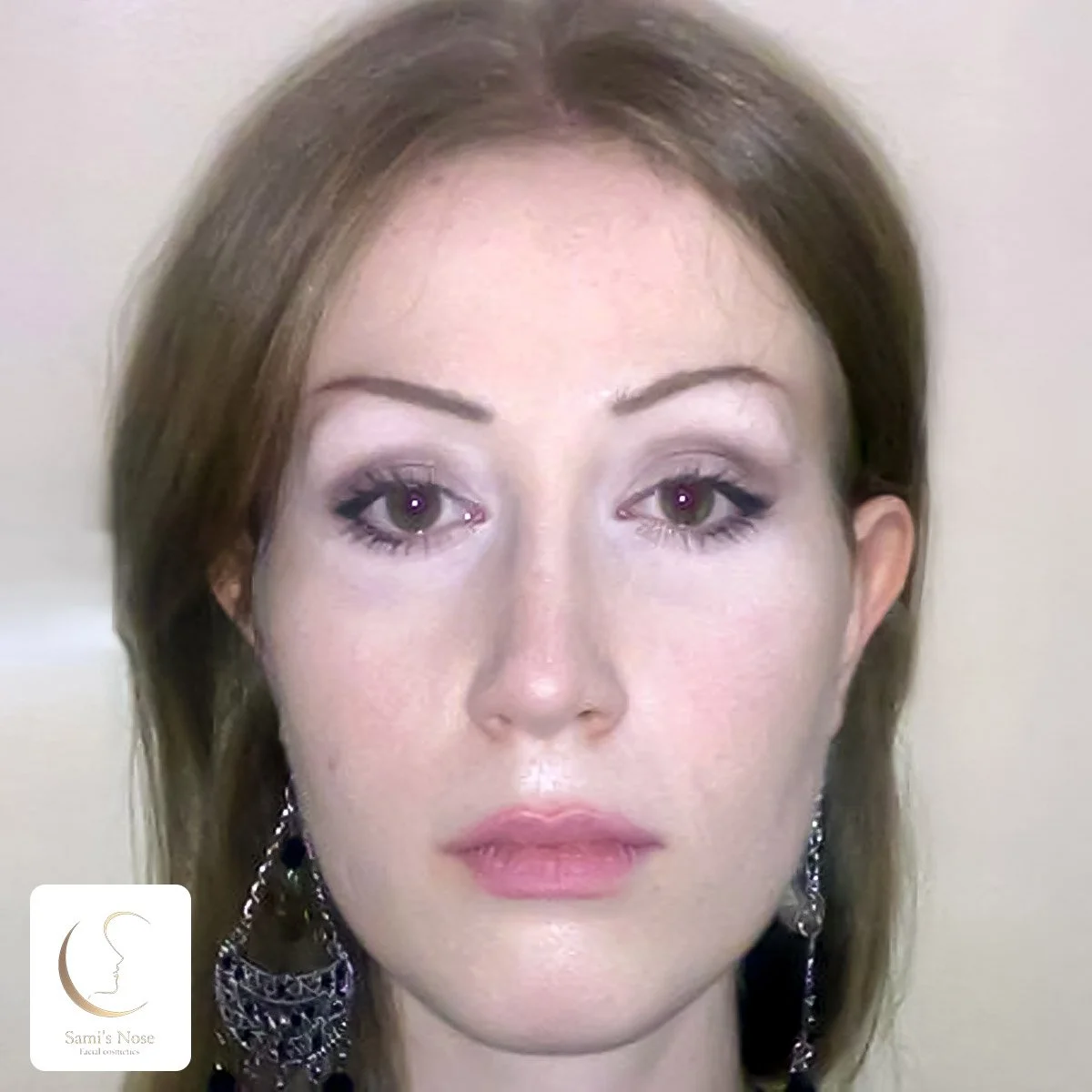 Patient 3 After Rhinoplasty