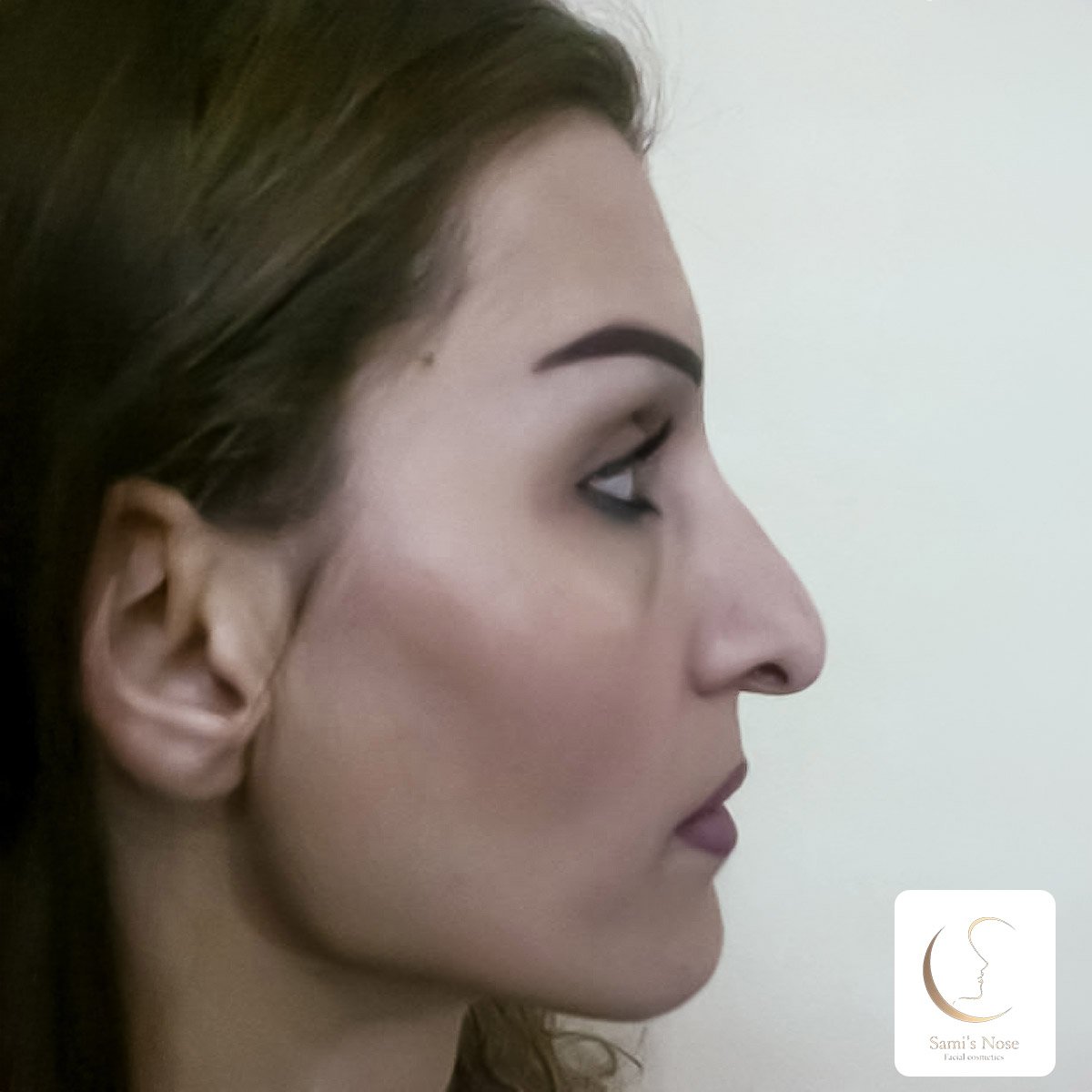 Patient 1 Before Rhinoplasty