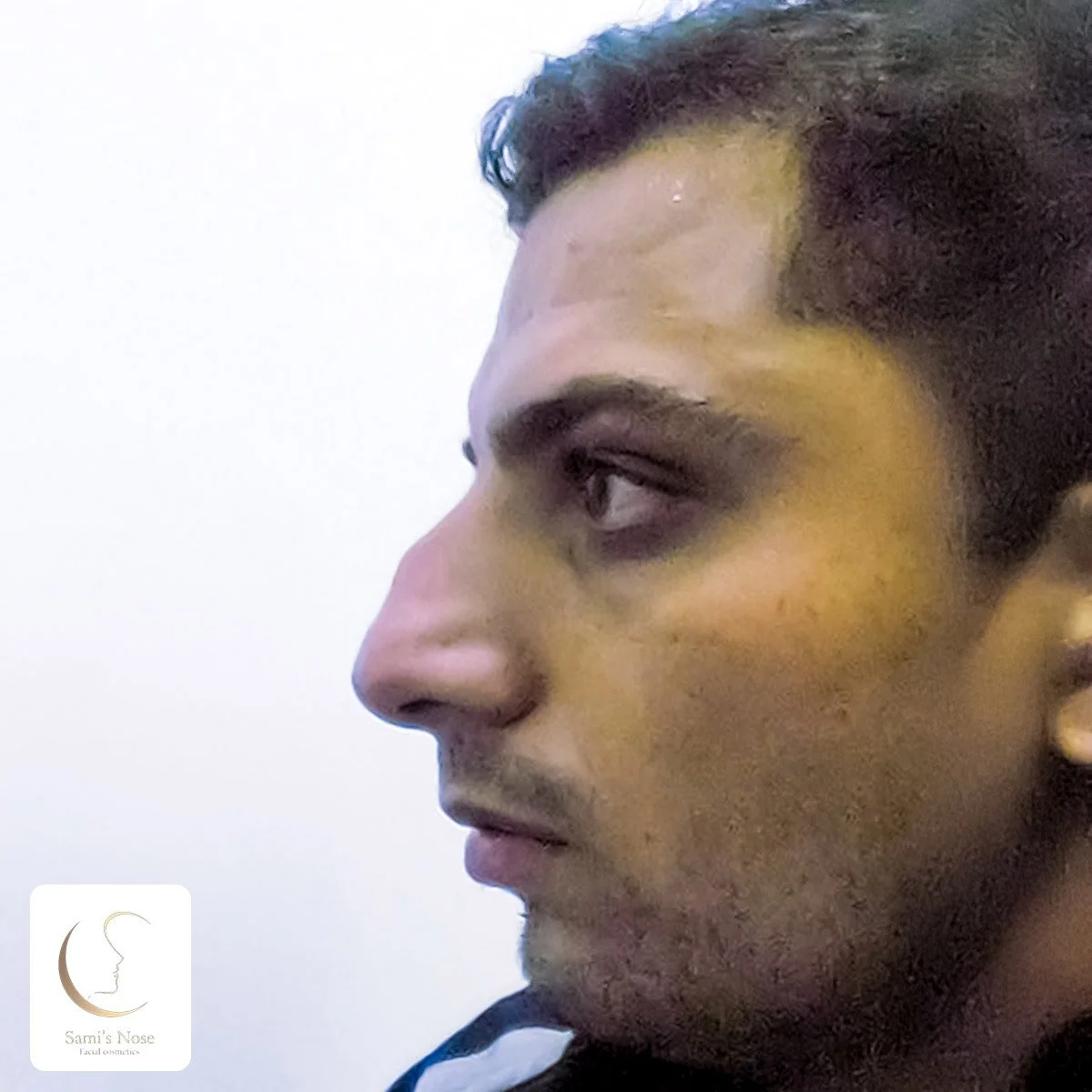 Patient 2 Before Rhinoplasty