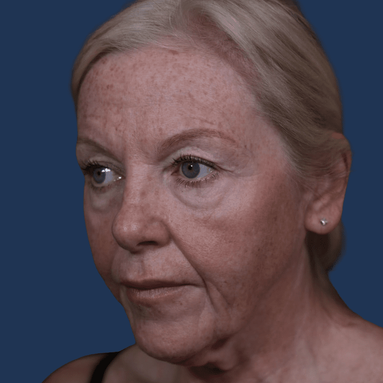 Before facelift at The Ghanem Clinic