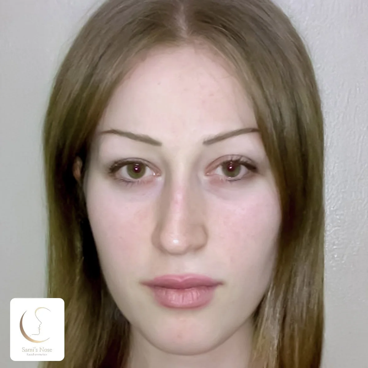 Patient 3 Before Rhinoplasty