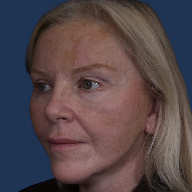 After facelift at The Ghanem Clinic