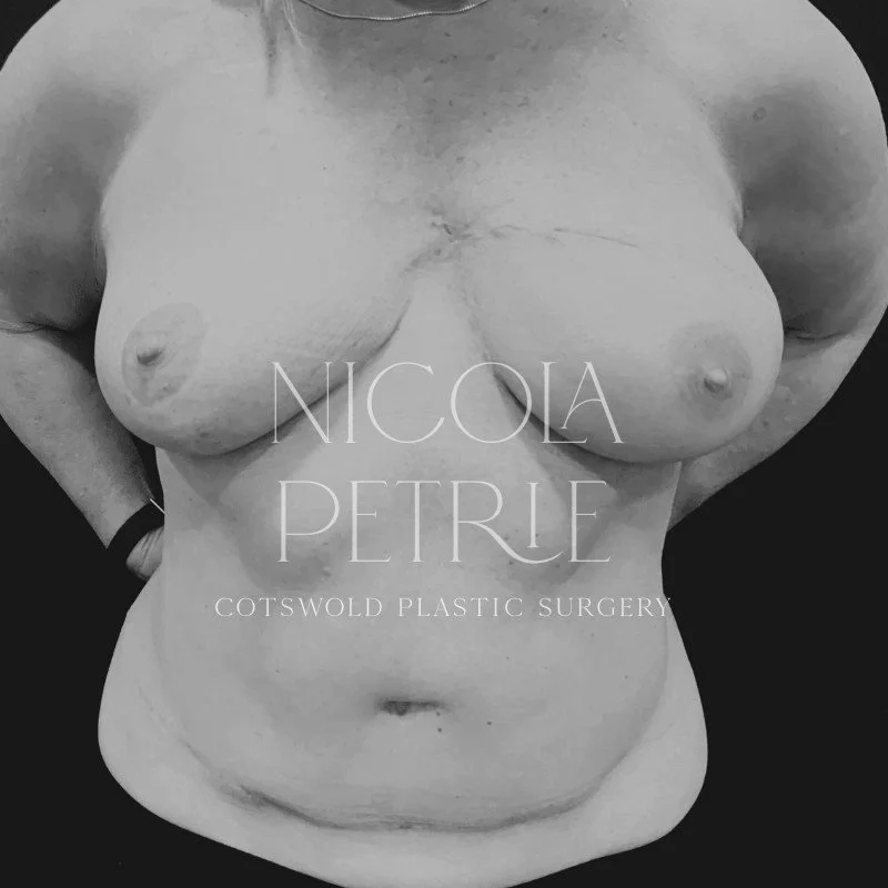 A black and white photo of a woman's torso, topless, with visible breasts and abdomen, with text overlay that reads "Nicola Petrie Cotswold Plastic Surgery."