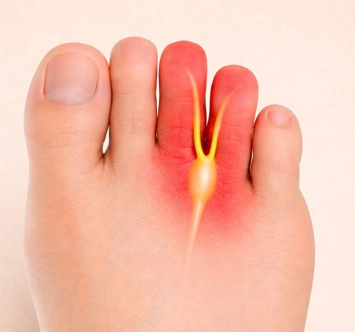 Morton’s neuroma causing nerve pain between the toes.