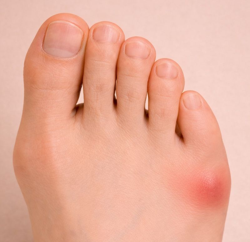 A close-up of a human foot with a Tailor’s bunion deformity (Bunionette) on the outside of the foot.