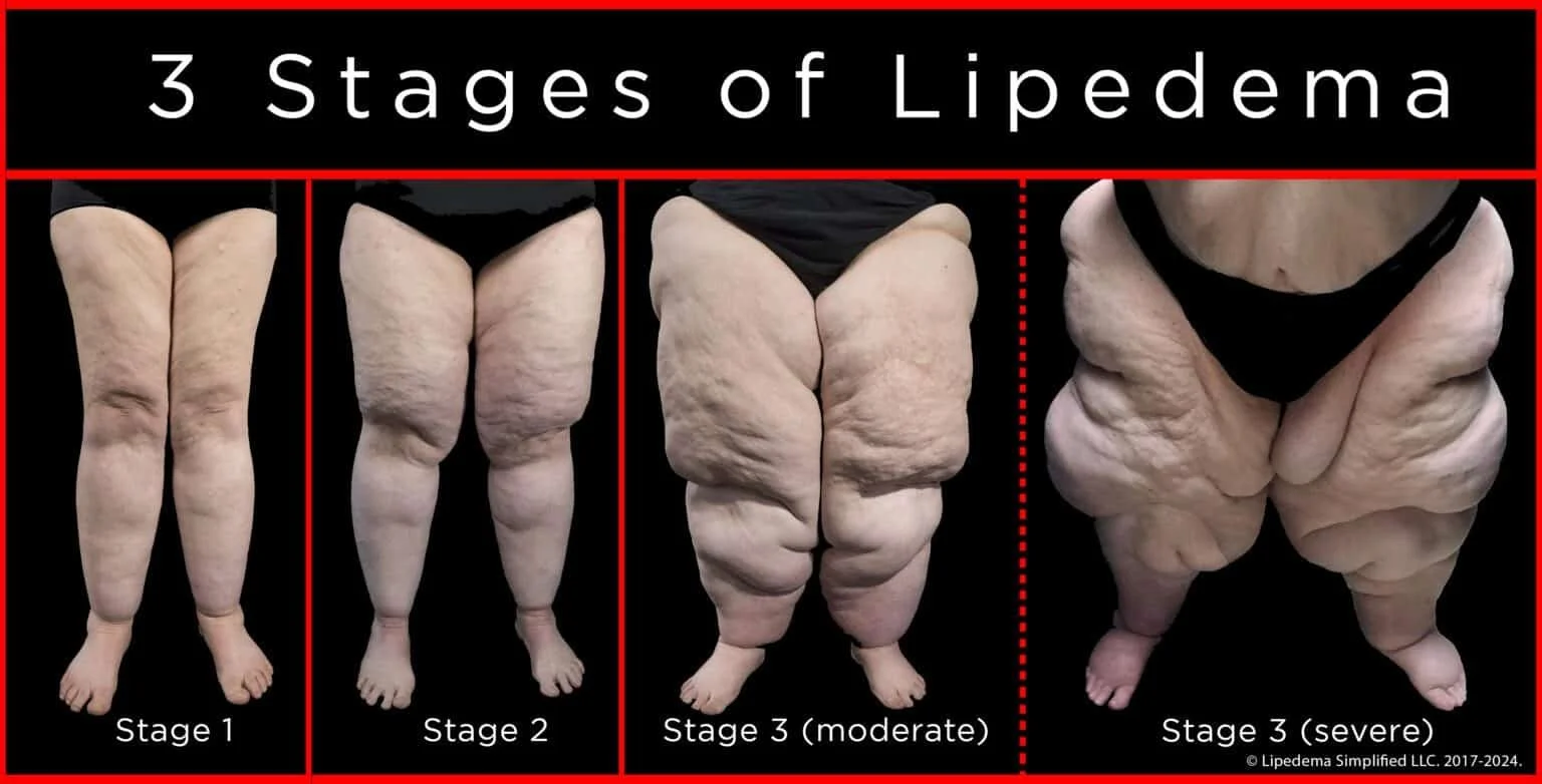 Lipedema and Chinese Herbal Medicine