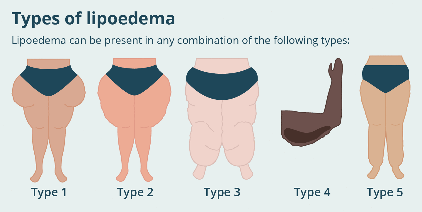 What is Lipedema?