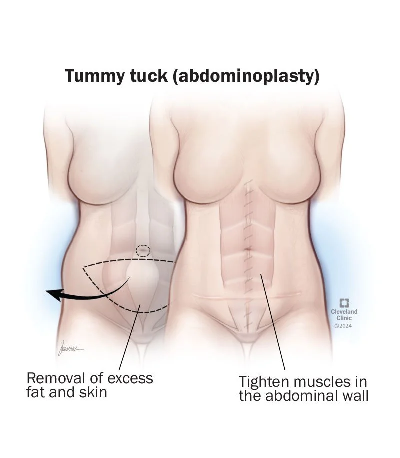 Lymphatic Massage and Cosmetic Surgery Recovery 