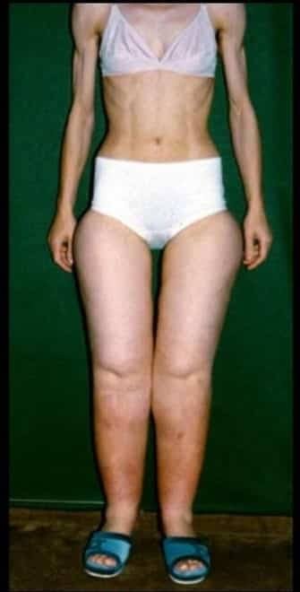 The Difference Between Lipedema, Lymphedema, and Obesity