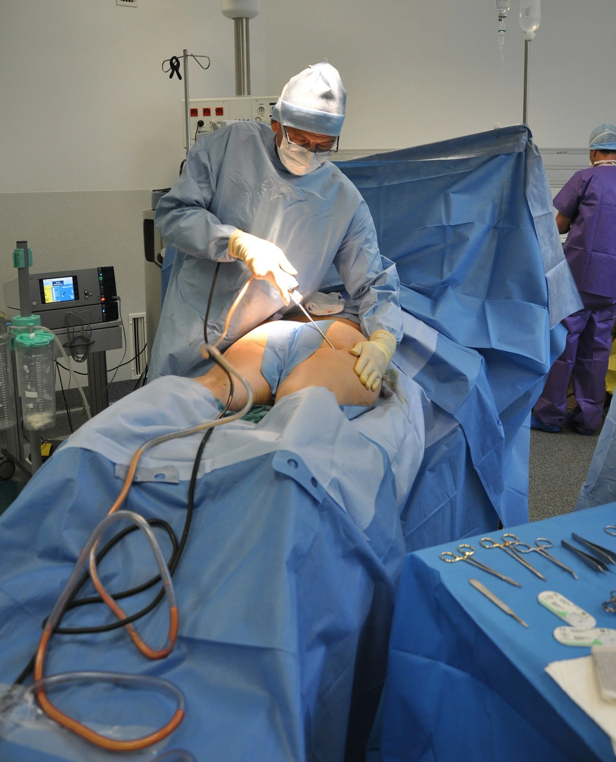 What Is Fibrosis After Liposuction? Understanding the Healing Process and How to Treat It