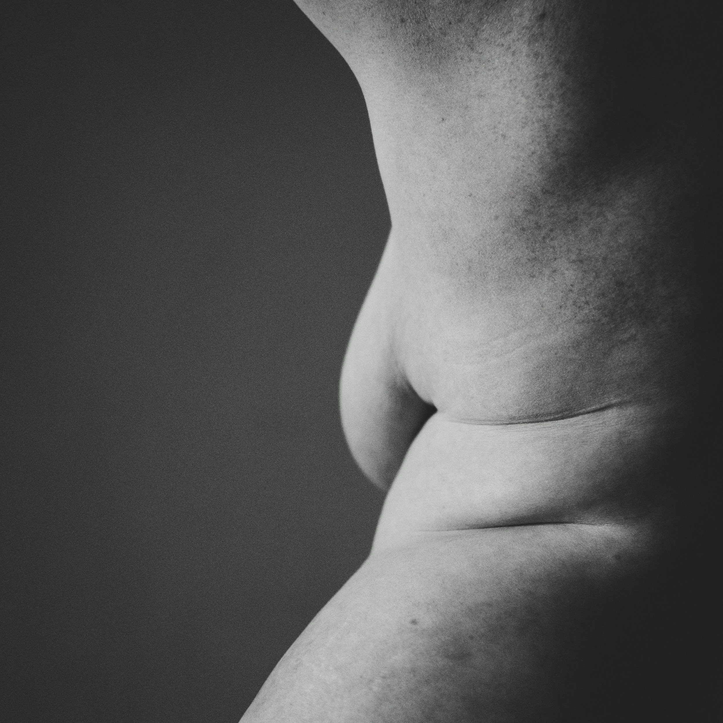 Lipedema and Chinese Herbal Medicine