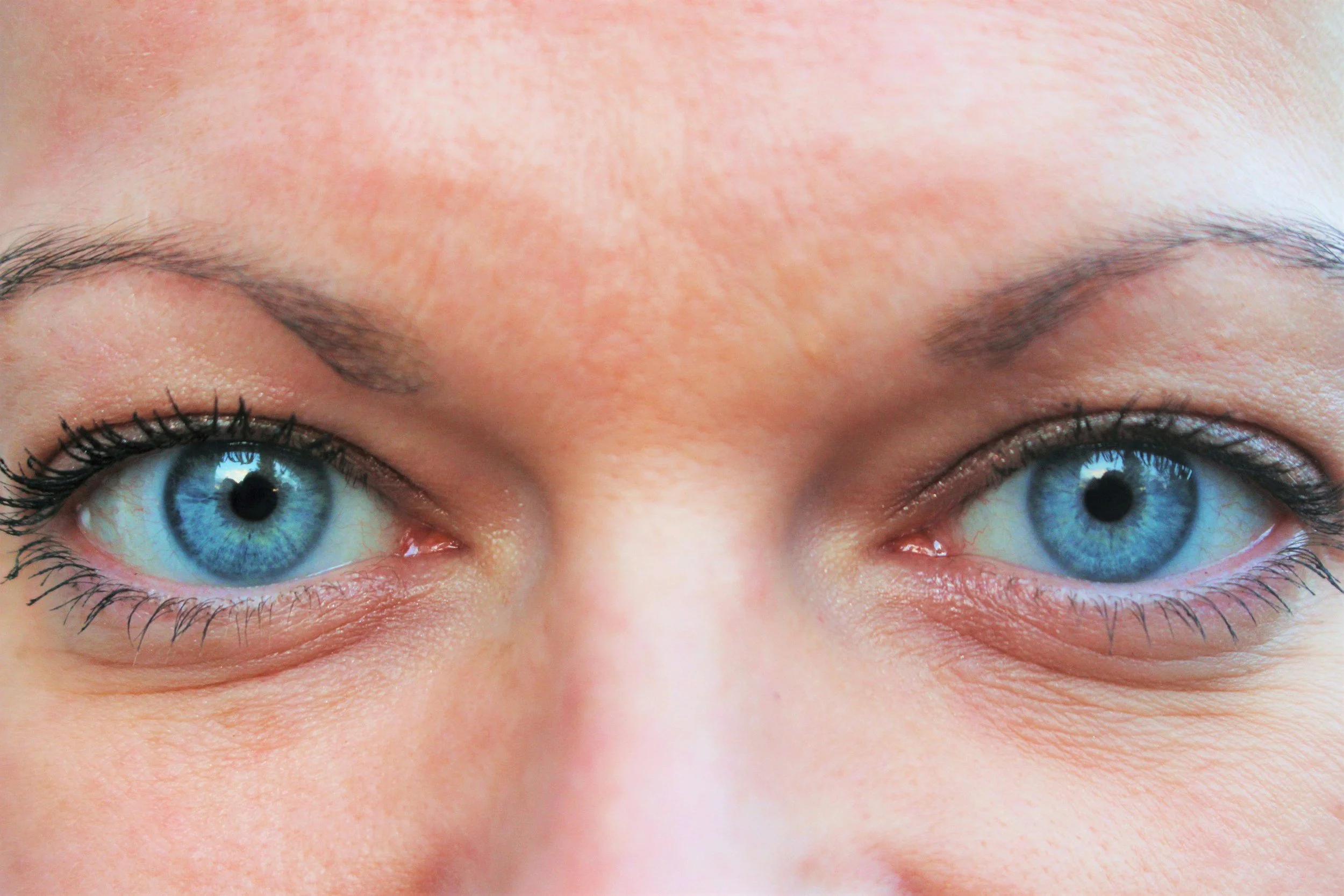 Case Study: Managing Chronic Facial Puffiness with Manual Lymphatic Drainage
