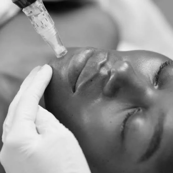 SkinPen® Microneedling and PN