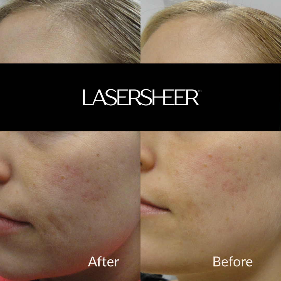 Laser Sheer Skin Rejuvenation St. Albert