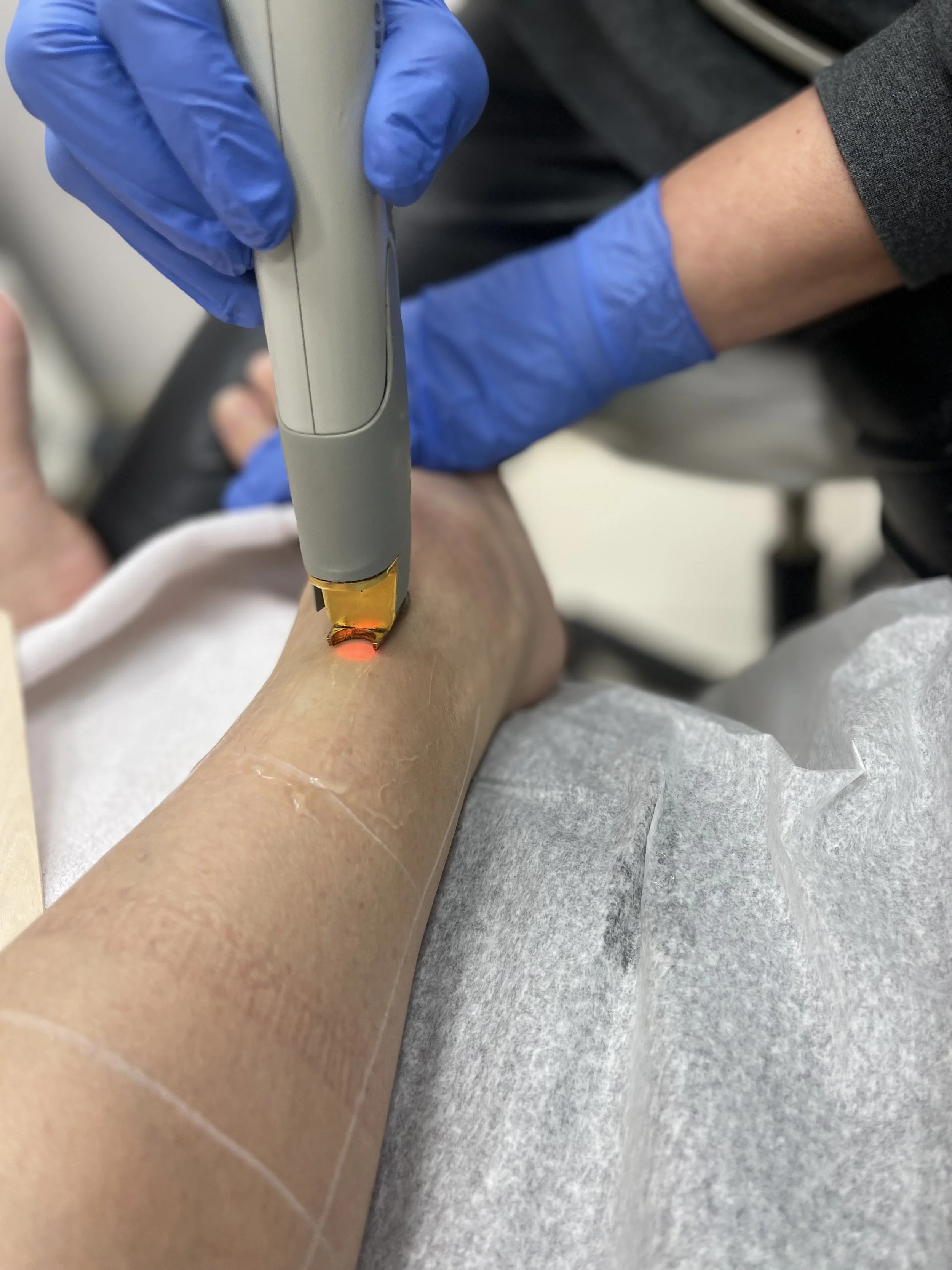 A medical professional in blue gloves performing a laser procedure on a person's forearm in a clinical setting.