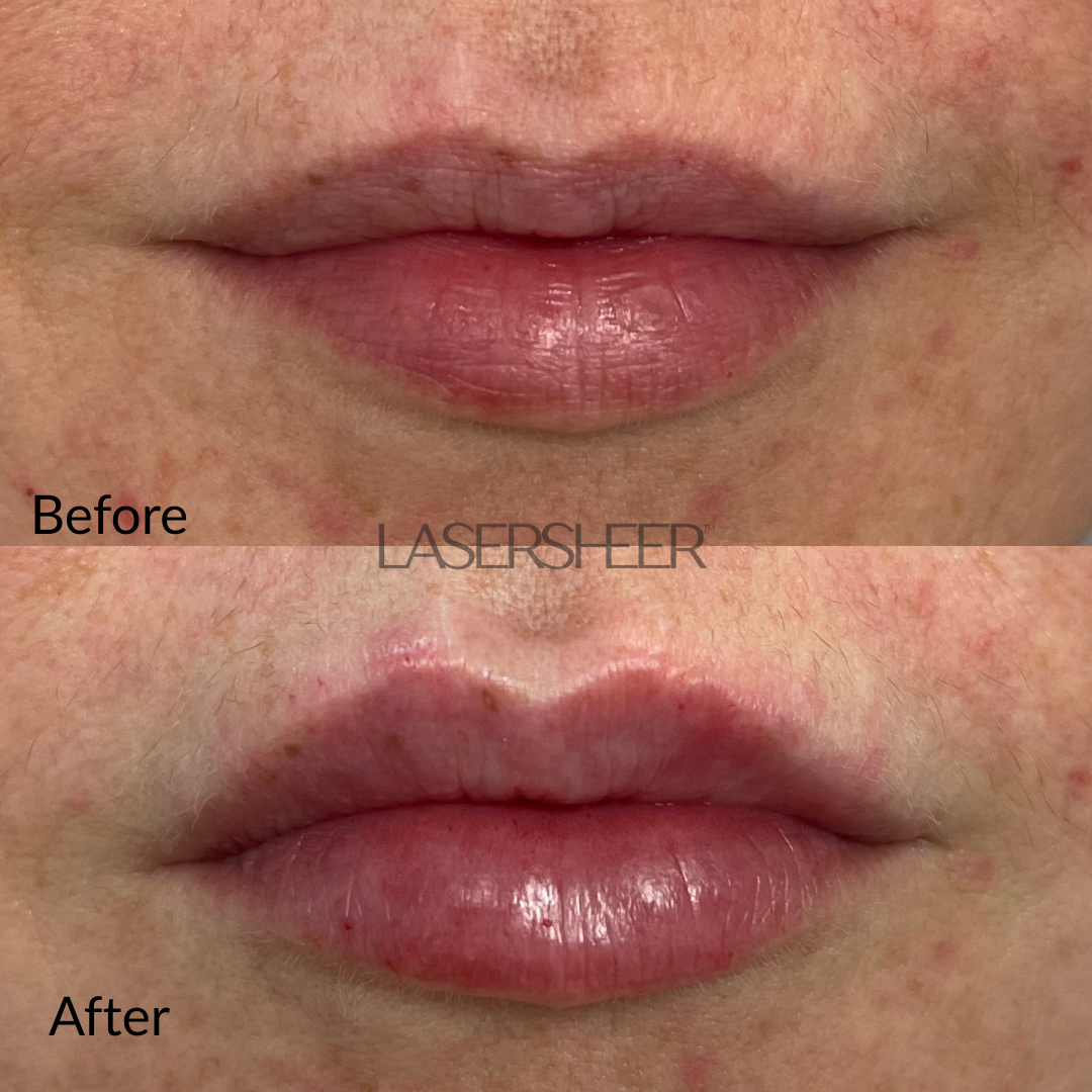 Laser Sheer Lip Filler Edmonton