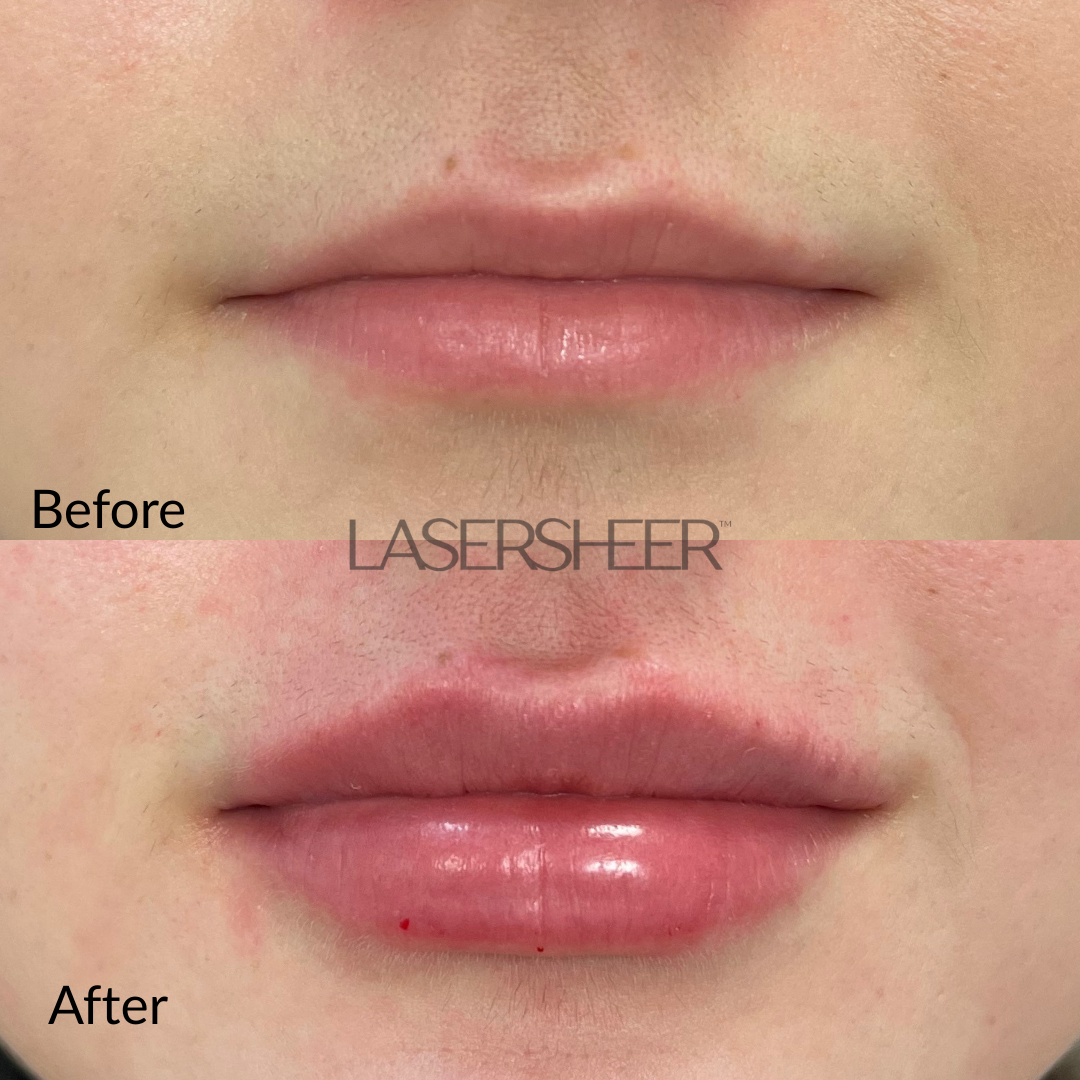 Lip Filler Edmonton Laser Sheer