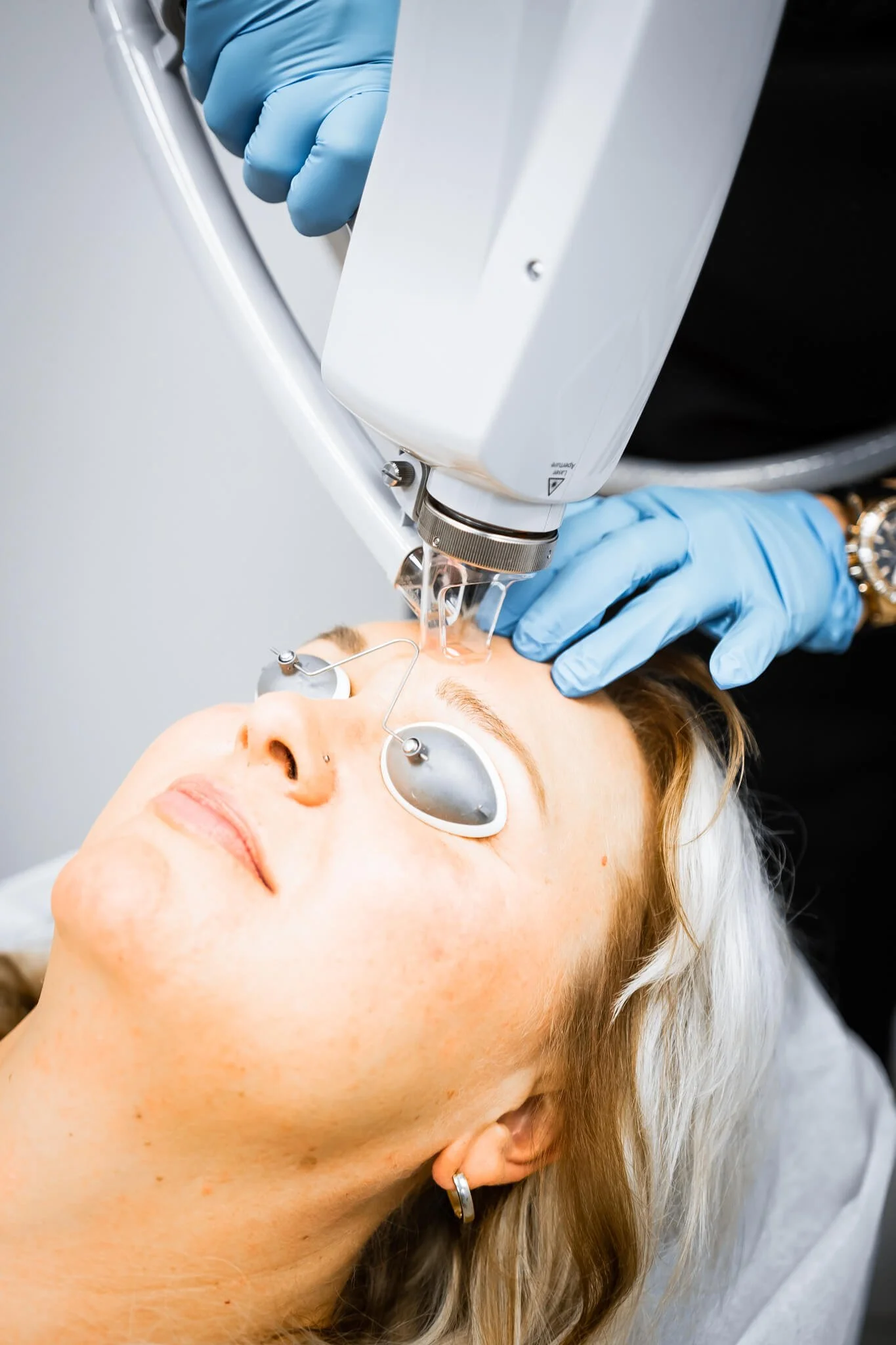 A woman receiving a laser eye treatment while wearing protective eye gear, with a technician in blue gloves administering the procedure.