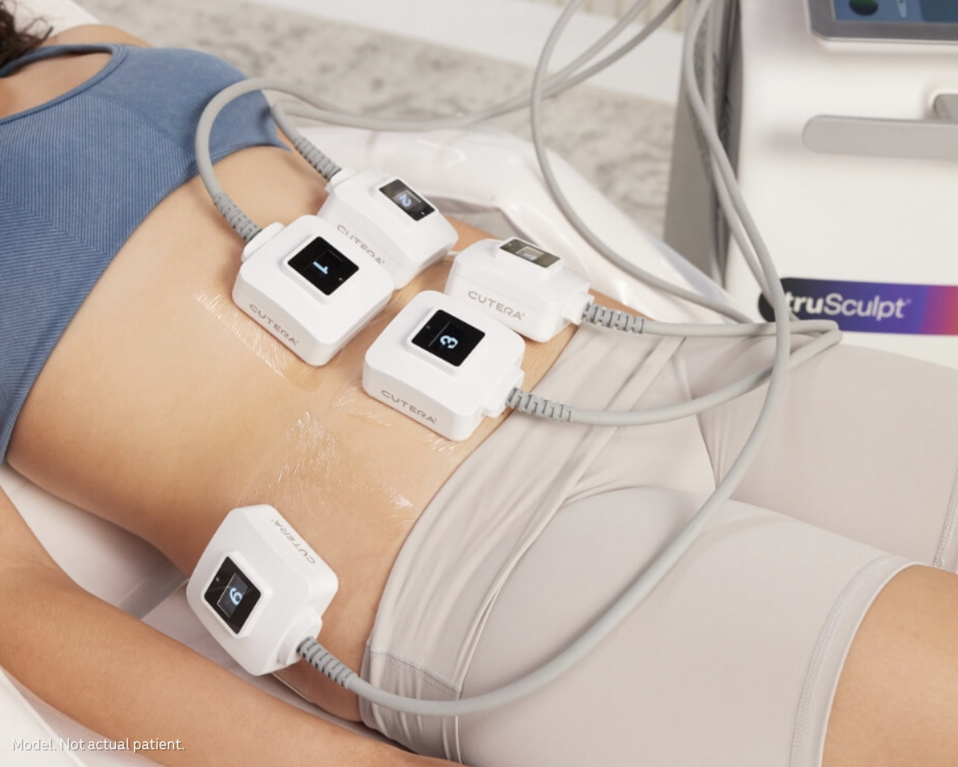 Person lying on a medical treatment table with multiple skin tightening devices attached to their abdomen, connected to a medical machine labeled 'truSculpt'. Laser Sheer Edmonton